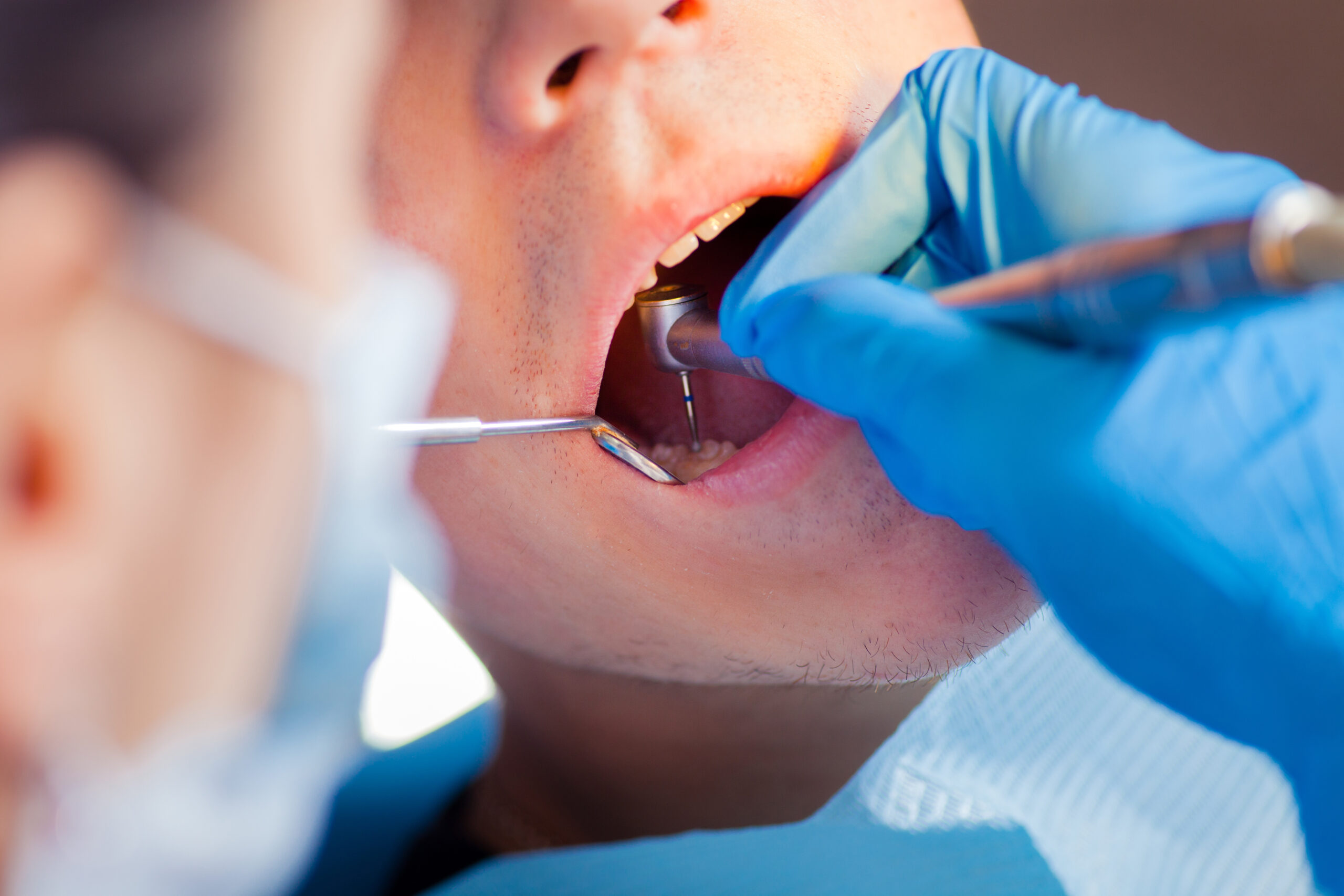 dentist examining a patients tooth that may need to be extracted