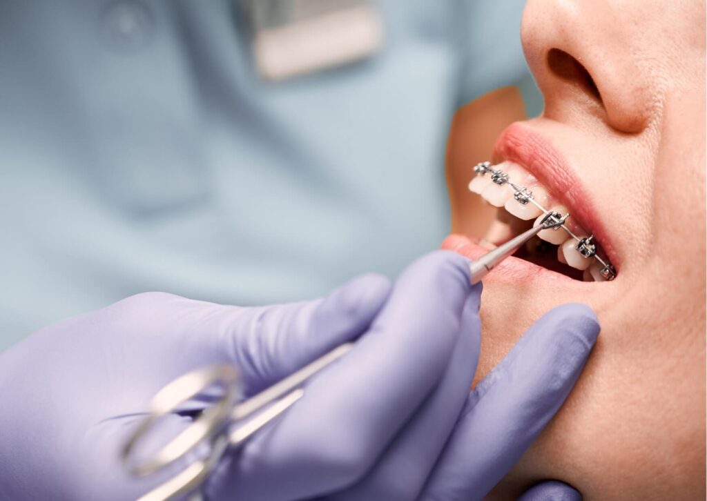 Orthodontist adjusting braces while explaining which types of candy are safe to eat with braces.