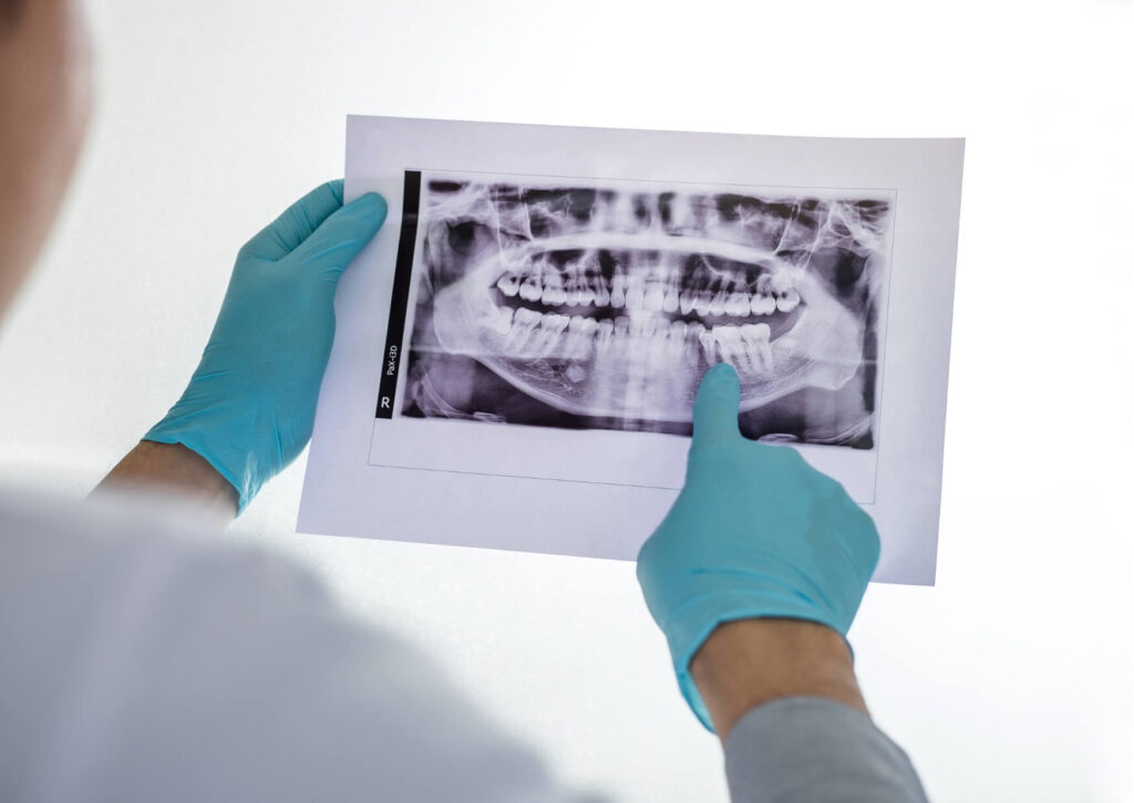 Dentist reviewing a dental X-ray to evaluate the tooth roots and nerve before recommending treatment.