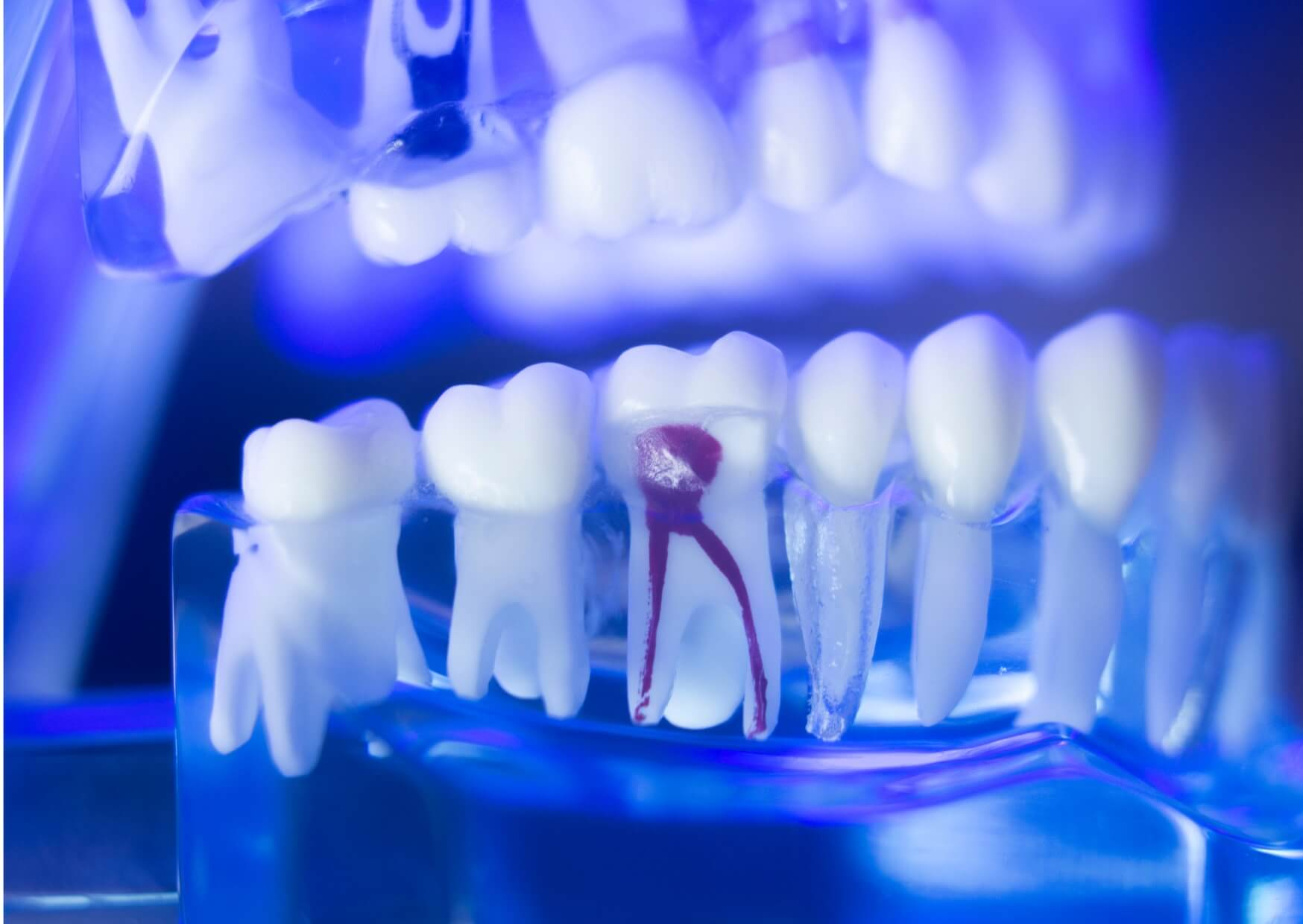 Dental model showing the inner pulp chamber and tooth nerve extending through the root to illustrate tooth anatomy.