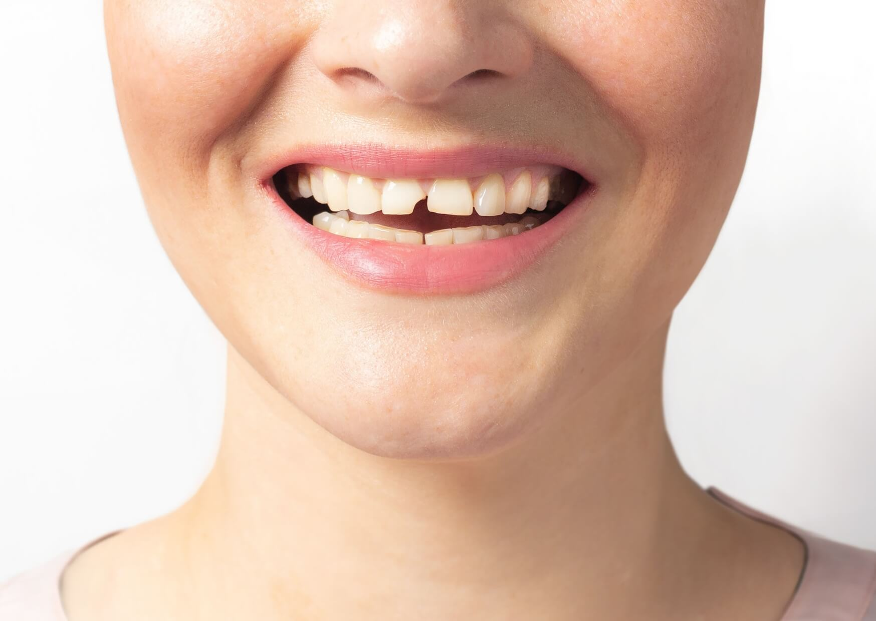 Close-up of a smile showing a chipped front tooth, illustrating what a cracked tooth can look like before dental treatment.