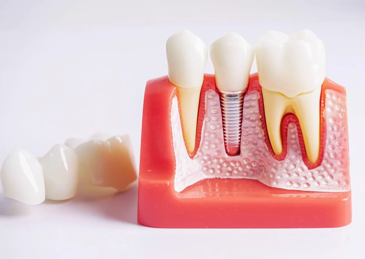 Dental implant model showing the implant post, crown, and surrounding bone during the dental implant timeline.