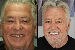 dental implant b&a