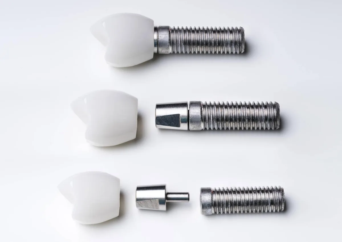 Dental implant components shown separated to illustrate how dental implant failure may involve the crown, abutment, or implant fixture.